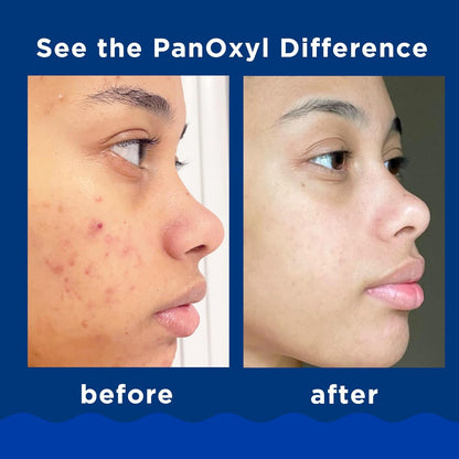 PanOxyl Acne Foaming Wash Benzoyl Peroxide 10%